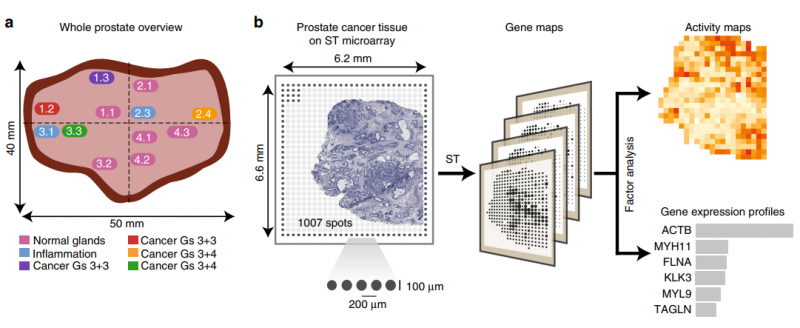 前列腺癌的空间转录组学（ST) 研究设计
